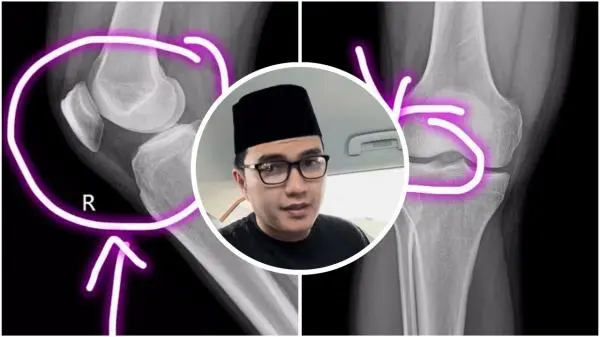 Aldi Taher Khawatir Pengapuran Tulang yang Diidapnya Efek dari Kemoterapi Kanker